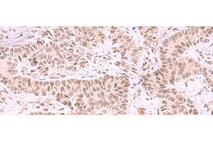 Immunohistochemistry of paraffin-embedded Human ovarian cancer tissue using MCMBP Polyclonal Antibody at dilution of 1:35(x200)