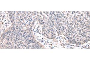 Immunohistochemistry of paraffin-embedded Human lung cancer tissue using ZNF239 Polyclonal Antibody at dilution of 1:25(x200)