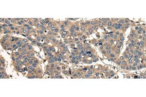 Immunohistochemistry of paraffin-embedded Human liver cancer tissue using CORO1B Polyclonal Antibody at dilution of 1:40(x200)