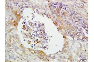 Formalin-fixed and paraffin embedded human lung carcinoma labeled with Anti-CD14 Polyclonal Antibody, unconjugated  (ABIN673164)  at 1: 200 followed by incubation with conjugated secondary antibody and DAB staining