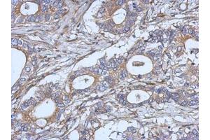 IHC-P Image Immunohistochemical analysis of paraffin-embedded human gastric cancer, using IL2, antibody at 1:500 dilution.