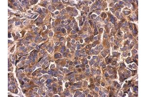IHC-P Image Survivin antibody detects Survivin protein at cytosol on human breast carcinoma by immunohistochemical analysis.