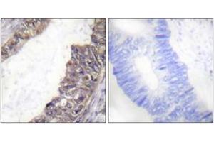 Immunohistochemistry analysis of paraffin-embedded human colon carcinoma, using GIRK1/KIR3.
