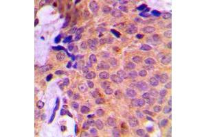 Immunohistochemical analysis of UBA2 staining in human breast cancer formalin fixed paraffin embedded tissue section.