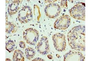 Immunohistochemistry of paraffin-embedded human breast cancer using ABIN7164708 at dilution of 1:100