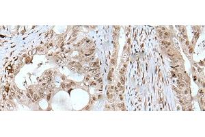 Immunohistochemistry of paraffin-embedded Human colorectal cancer tissue using USP3 Polyclonal Antibody at dilution of 1:50(x200)