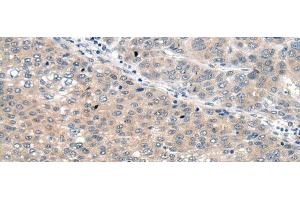 Immunohistochemistry of paraffin-embedded Human liver cancer tissue using SEMA4D Polyclonal Antibody at dilution of 1:60(x200)