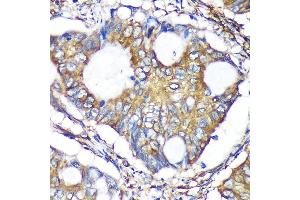 Immunohistochemistry of paraffin-embedded Human colon carcinoma using B Rabbit pAb (ABIN7265675) at dilution of 1:100 (40x lens).