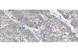 Immunohistochemistry of paraffin-embedded Human liver cancer tissue using XIRP1 Polyclonal Antibody at dilution of 1:90(x200)