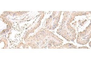Immunohistochemistry of paraffin-embedded Human thyroid cancer tissue using ERGIC3 Polyclonal Antibody at dilution of 1:50(x200)