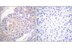 Immunohistochemistry analysis of paraffin-embedded human breast carcinoma, using p130 Cas (Phospho-Tyr165) Antibody.