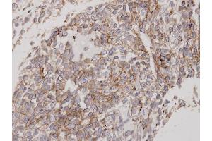 Immunohistochemical staining of paraffin-embedded Lung CA using Flotillin 2 antibody at a dilution of 1:100
