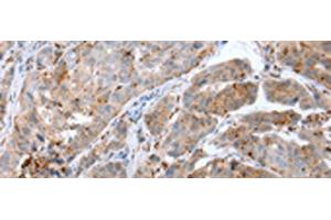 Immunohistochemistry of paraffin-embedded Human breast cancer tissue using CALB2 Polyclonal Antibody at dilution of 1:25(x200)