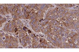 ABIN6273838 at 1/100 staining Human liver cancer tissue by IHC-P.