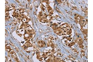 The image on the left is immunohistochemistry of paraffin-embedded Human breast cancer tissue using ABIN7192079(PUS10 Antibody) at dilution 1/45, on the right is treated with synthetic peptide.