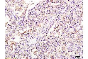Formalin-fixed and paraffin embedded human pneumonitis tissue labeled with Anti-FPRL1/RFP/Lipoxin A4 receptor Polyclonal Antibody, Unconjugated (ABIN702175) at 1:200 followed by conjugation to the secondary antibody and DAB staining