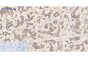 Immunohistochemistry of paraffin-embedded Human liver cancer tissue with Phospho-JAK1 (Tyr1022) Polyclonal Antibody at dilution of 1:200