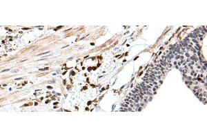 Immunohistochemistry of paraffin-embedded Human gastric cancer tissue using ARHGDIB Polyclonal Antibody at dilution of 1:35(x200)