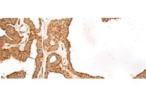 Immunohistochemistry of paraffin-embedded Human thyroid cancer tissue using GBGT1 Polyclonal Antibody at dilution of 1:40(x200)