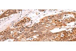 Immunohistochemistry of paraffin-embedded Human esophagus cancer tissue using RRP8 Polyclonal Antibody at dilution of 1:80(x200)