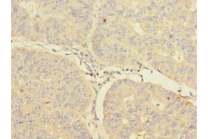 Immunohistochemistry of paraffin-embedded human endometrial cancer using ABIN7148571 at dilution of 1:100