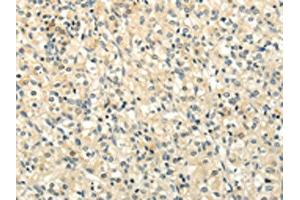 The image on the left is immunohistochemistry of paraffin-embedded Human prostate cancer tissue using ABIN7190020(BRWD1 Antibody) at dilution 1/20, on the right is treated with synthetic peptide.