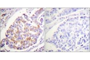 Immunohistochemistry analysis of paraffin-embedded human breast carcinoma, using ADD1 (Phospho-Ser726) Antibody.