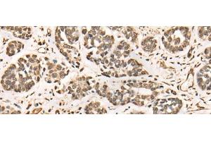 Immunohistochemistry of paraffin-embedded Human esophagus cancer tissue using BRD7 Polyclonal Antibody at dilution of 1:50(x200)