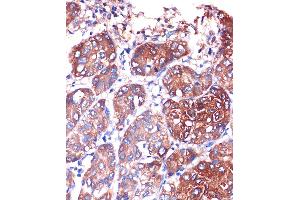 Immunohistochemistry of paraffin-embedded Human liver cancer using LYPL Rabbit pAb (ABIN1680728, ABIN3018907, ABIN3018908 and ABIN6220622) at dilution of 1:100 (40x lens).