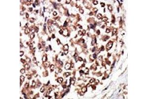 IHC analysis of FFPE human hepatocarcinoma tissue stained with the PKC nu antibody