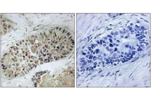 Immunohistochemistry analysis of paraffin-embedded human lung carcinoma, using Artemis (Phospho-Ser516) Antibody.