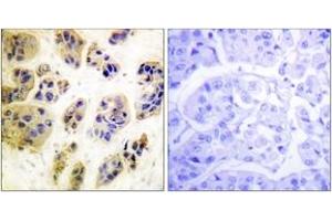 Immunohistochemistry analysis of paraffin-embedded human breast carcinoma, using CBL (Phospho-Tyr700) Antibody.