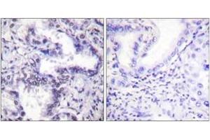 Immunohistochemistry analysis of paraffin-embedded human lung carcinoma, using Ku80 (Phospho-Thr714) Antibody.