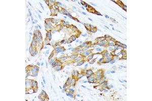 Immunohistochemistry of paraffin-embedded human esophageal cancer using STIP1 Rabbit mAb (ABIN1512566, ABIN3020619, ABIN3020620 and ABIN7101303) at dilution of 1:100 (40x lens).
