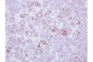IHC-P Image Immunohistochemical analysis of paraffin-embedded human lung adenocarcinoma, using MMP13, antibody at 1:250 dilution.
