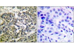 Immunohistochemistry analysis of paraffin-embedded human breast carcinoma, using AMPK alpha (Phospho-Thr172) Antibody.