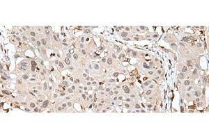 Immunohistochemistry of paraffin-embedded Human esophagus cancer tissue using ARHGDIB Polyclonal Antibody at dilution of 1:35(x200)