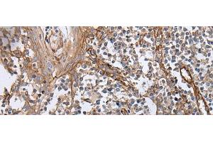 Immunohistochemistry of paraffin-embedded Human tonsil tissue using BLVRB Polyclonal Antibody at dilution of 1:65(x200)