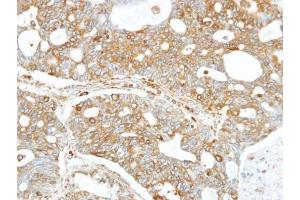 IHC-P Image Immunohistochemical analysis of paraffin-embedded OVCA xenograft, using FANCC, antibody at 1:100 dilution.