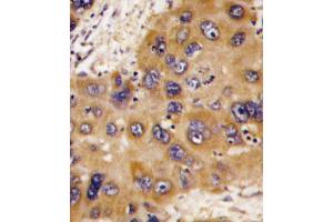 Formalin-fixed and paraffin-embedded human hepatocarcinoma tissue reacted with HNMT antibody , which was peroxidase-conjugated to the secondary antibody, followed by DAB staining.