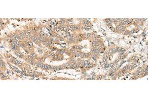 Immunohistochemistry of paraffin-embedded Human liver cancer tissue using CPNE4 Polyclonal Antibody at dilution of 1:40(x200)