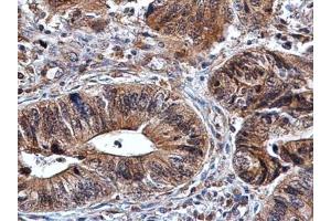 IHC-P Image Amphiregulin antibody detects Amphiregulin protein at cytoplasm in human colon cancer by immunohistochemical analysis.