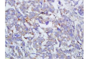 Formalin-fixed and paraffin embedded human lung cancer labeled with Anti-Complement C4/C4 Polyclonal Antibody, Unconjugated  at 1:200 followed by conjugation to the secondary antibody and DAB staining