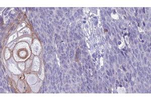 ABIN6272629 at 1/100 staining Human Head and neck cancer tissue by IHC-P.