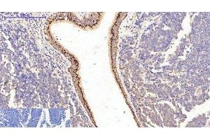 Immunohistochemistry of paraffin-embedded Human lung cancer tissue using COL1A1 Monoclonal Antibody at dilution of 1:200.