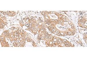 Immunohistochemistry of paraffin-embedded Human gastric cancer tissue using SEC11A Polyclonal Antibody at dilution of 1:45(x200)