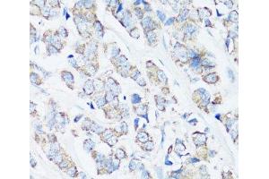 Immunohistochemistry of paraffin-embedded Human breast cancer using SRC Polyclonal Antibody at dilution of 1:100 (40x lens).