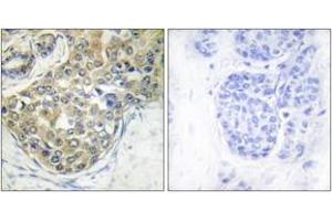 Immunohistochemistry analysis of paraffin-embedded human breast carcinoma, using ACK1 (Phospho-Tyr284) Antibody.