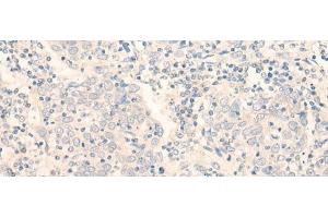 Immunohistochemistry of paraffin-embedded Human cervical cancer tissue using ADGRE3 Polyclonal Antibody at dilution of 1:35(x200)