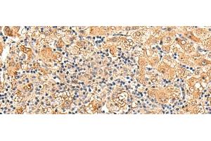 Immunohistochemistry of paraffin-embedded Human liver cancer tissue using GPD1L Polyclonal Antibody at dilution of 1:60(x200)
